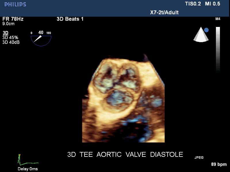 Philips iE33 xMatrix