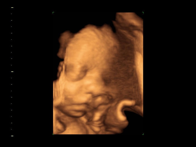 GE Logiq S7 с XDClear