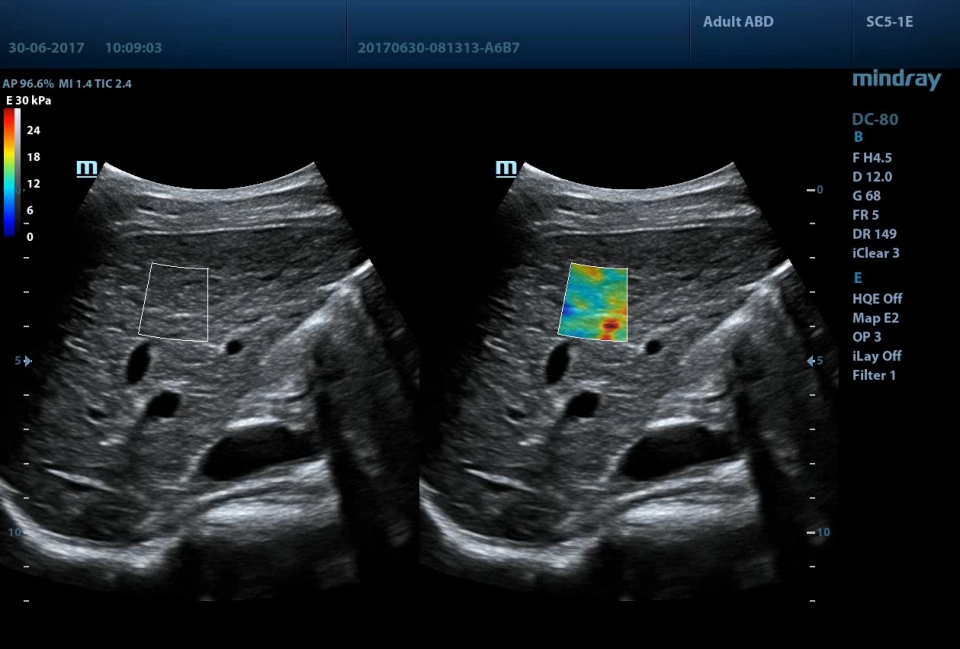Mindray DC-80 X-Insight